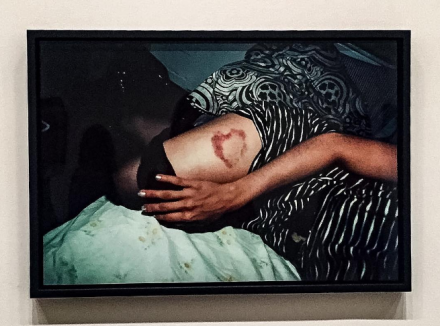 Nan Goldin, Heart-Shaped Bruise, New York City (1980), via Art Observed